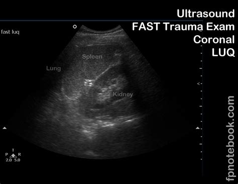 Fast Exam Ultrasound