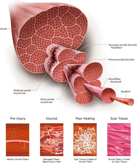 Pulled Muscle Treatment: Get Back To Your Normal Activities Quickly