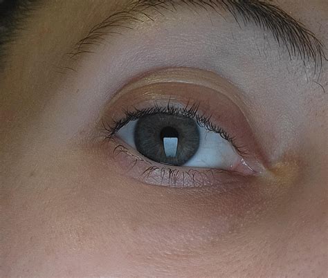 Bumps under eyes? : r/30PlusSkinCare