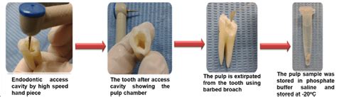 Image result for Pulp Extraction Tooth