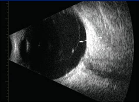 Posterior vitreous detachment | Viewpoint