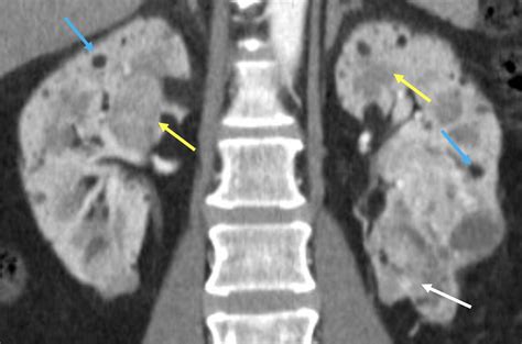 Abdominal Manifestations of Tuberous Sclerosis Complex | Applied Radiology