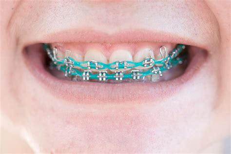 Braces Colors For Each Month at Dean Ransford blog