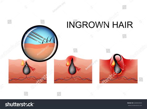 Infected Ingrown Hairs