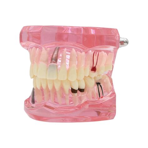 Buy Dentalmall Teeth Model Teeth Typodonts Dental Implant Study ...