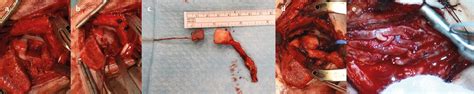 Knochen-Knorpeltransplantate vom Femurzur Rekonstruktion von Talusdefe ...