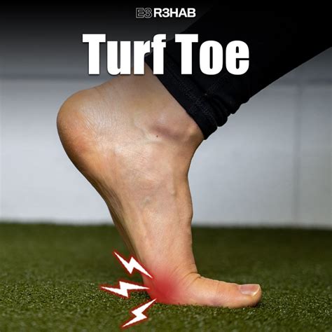 Turf Toe Turf Toe Surgery & Treatment Irvine Orange County Podiatrist