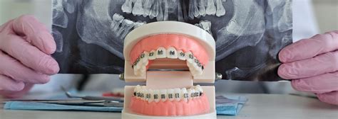 Indirect Bonding Explained | MOA St. Louis