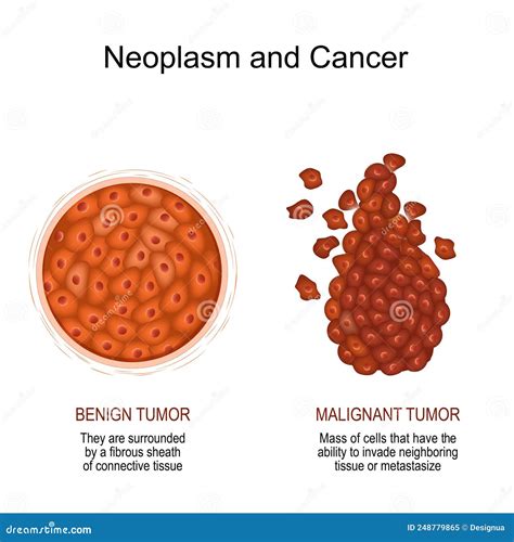 Neoplasm and Cancer. Malignant and Benign Tumor Stock Vector - Illustration of immune ...