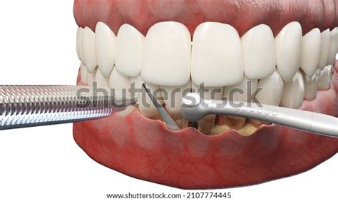 Image result for Gum Paste Pocketing