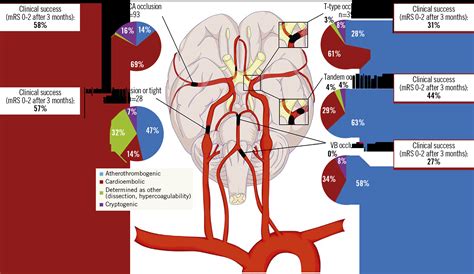 Occluded Left Internal Carotid Artery