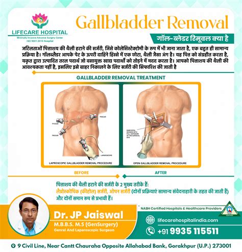 Image result for How to Remove Gallbladder