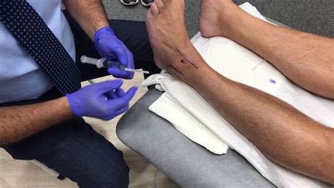 Image result for Ankle Injection Lateral Approach