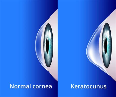 Corneal Cross Linking Treatments | Vision for Life Institute