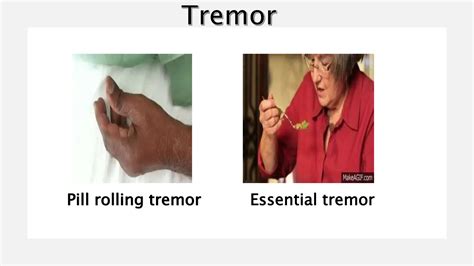Physiotherapy Assessment and management of Parkinson's disease | PPTX
