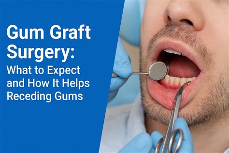 Gum Graft Surgery: What to Expect & How It Helps Receding Gums