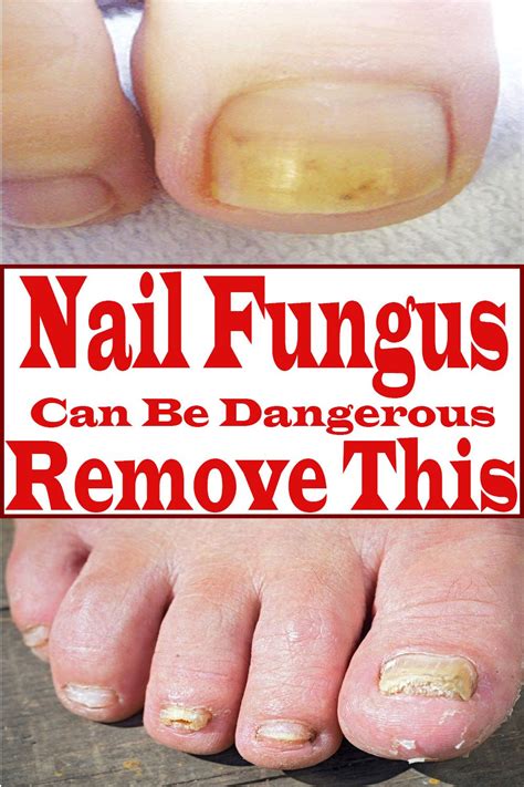 nail fungus from nail salon