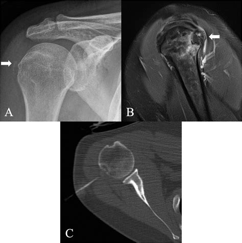 Calcium hydroxyapatite deposition disease: Imaging features and ...