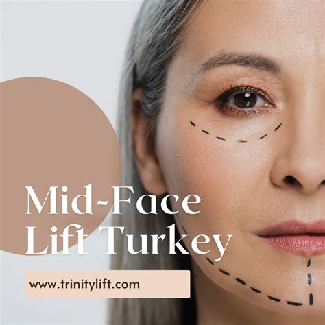 Mid-face Lift Turkey - Trinity Lift