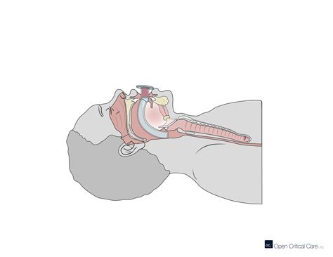 Oropharyngeal Airway Diagram
