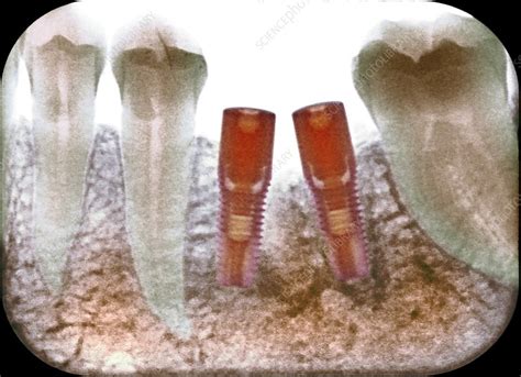 Dental implants following tooth extraction, X-ray - Stock Image - F028/1807 - Science Photo Library