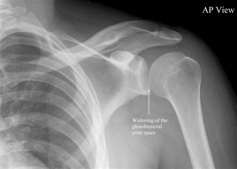 Image result for Posterior Shoulder Dislocation Sulcus Sign