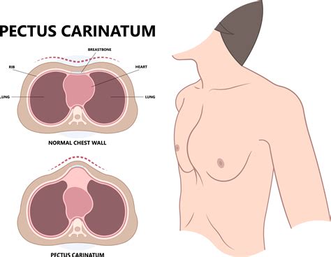 Pectus Carinatum Vs Excavatum Pectus Disorders Advances In