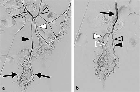 Embolization of the Superior Rectal Arteries versus Closed Hemorrhoidectomy (Ferguson Technique ...