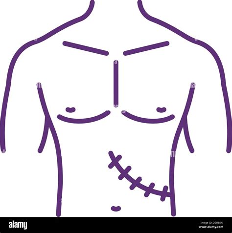 Liver Transplant Scar