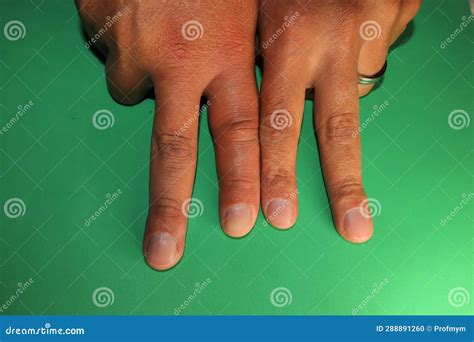 Swelling of the Right Index Finger by a Honey Bee Sting. Skin Allergy ...