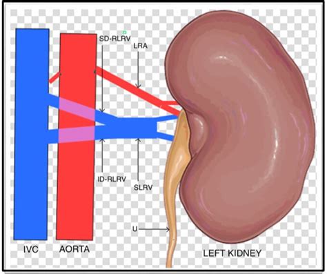 Double retro-aortic left renal vein—a rare anatomical variant | BMJ Case Reports