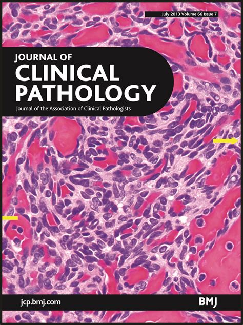 Urethral caruncle: a lesion related to IgG4-associated sclerosing ...