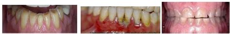 Chisel Dental Clinic | Deep Bite
