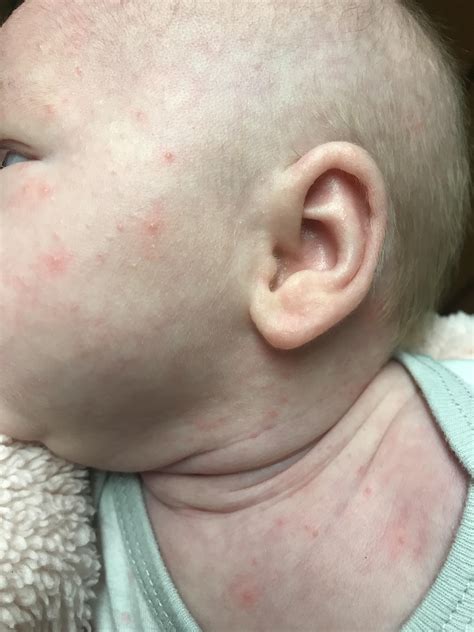 Baby Acne On Chest And Arms at Michelle Gilbert blog