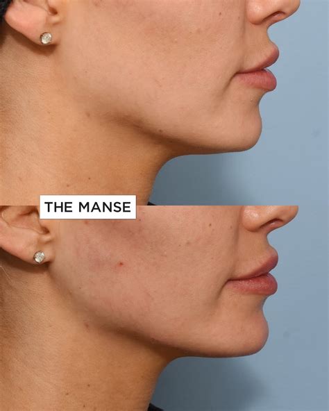 Dermal Fillers Jawline