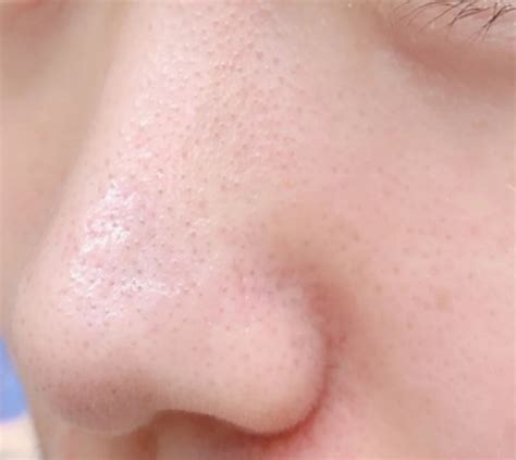 鼻子上的这些黑点是什么，如何除去？ - 知乎