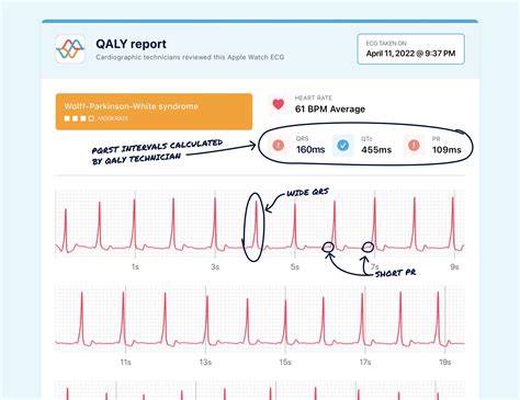 QRS Interval on Your Watch ECG - Narrow, Normal, and Wide | Qaly