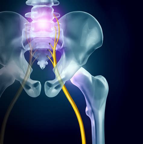 How Long Does It Take for Sciatica to Go Away? - Injured Call Today
