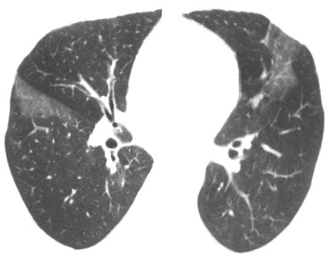 Hypersensitivity Pneumonitis: Spectrum of High-Resolution CT and ...