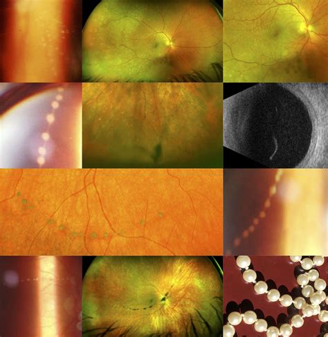 Aurora borealis and string of pearls in vitreoretinal lymphoma: patterns of vitreous haze ...