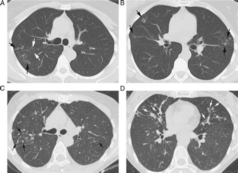 Causes and Imaging Patterns of Tree-in-Bud Opacities - CHEST
