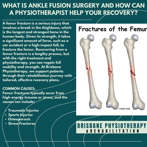 Oblique Fracture Healing Factors Influencing Fracture Healing Sara