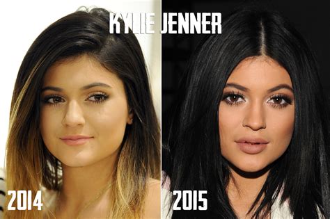 Kylie Jenner Lips Before And After | Lipstutorial.org