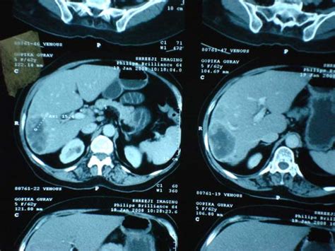 Liver Surgery Pictures, Images | LPC Mumbai