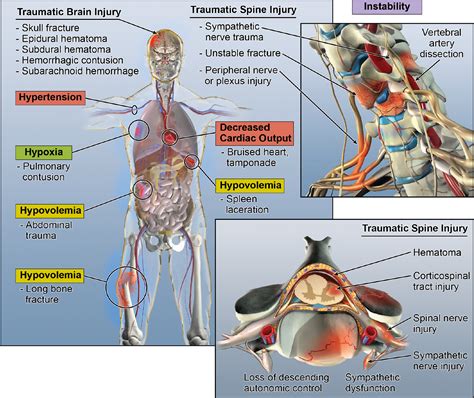 Update on critical care for acute spinal cord injury in the setting of ...