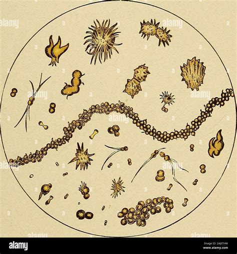 Amorphous Phosphate Crystals In Urine
