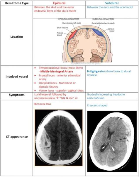 Subdural vs epidural hematoma neurology nursing and medical notes – Artofit
