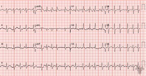 Left Posterior Fascicular Block | ECG Stampede