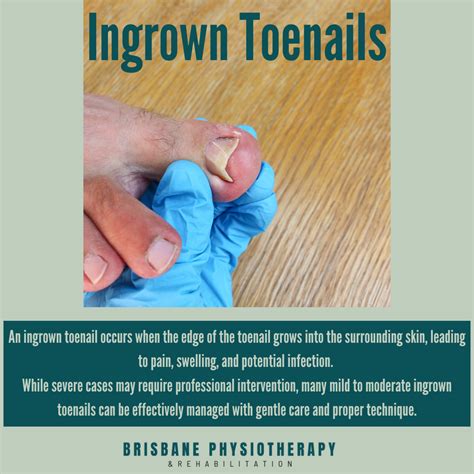Ingrown Toenail Treatment in Brisbane - Brisbane Physiotherapy & Podiatry
