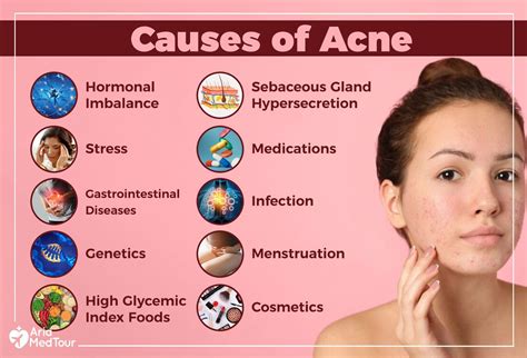 Causes of Acne - MEDizzy